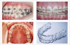 儿童牙齿矫正有哪些方法
