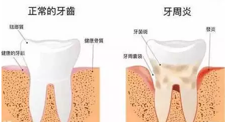 牙周炎的症状