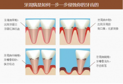 成年人牙龈出血牙周炎没什么大不了吗?