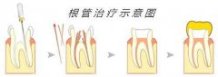 牙髓炎有哪些治疗方法及治疗原则?