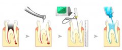 牙髓炎根管治疗及注意事项