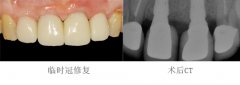 前牙种植烤瓷冠修复