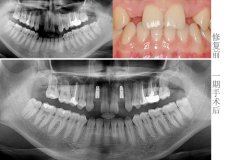 先天牙缺失种植来修复